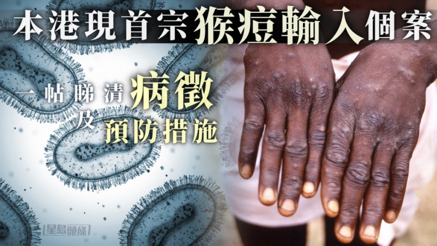 消息指，香港出現首宗猴痘輸入個案。istock圖片